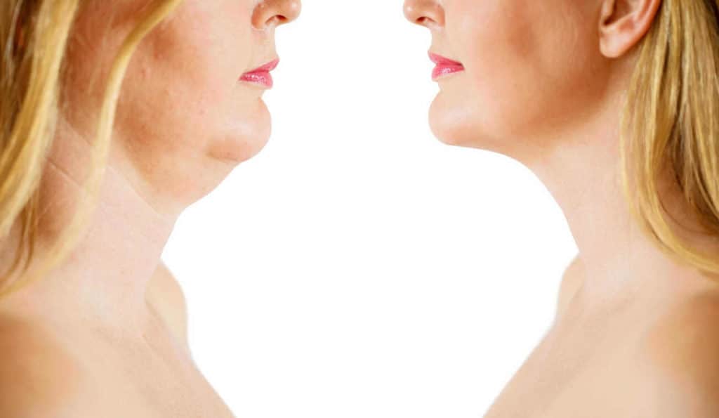 Double Chin treatment Chadwell Heath before and after results
