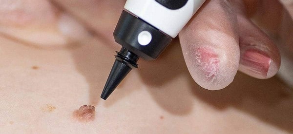 After Skin Tag Removal Chadwell Heath