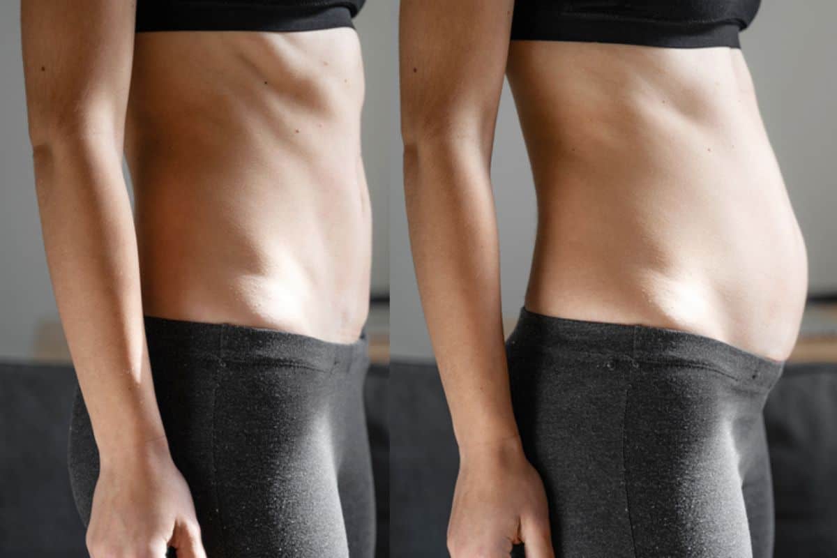 How long does diastasis recti take to improve Chadwell Heath?