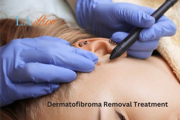 Dermatofibroma Removal Treatment Chadwell Heath