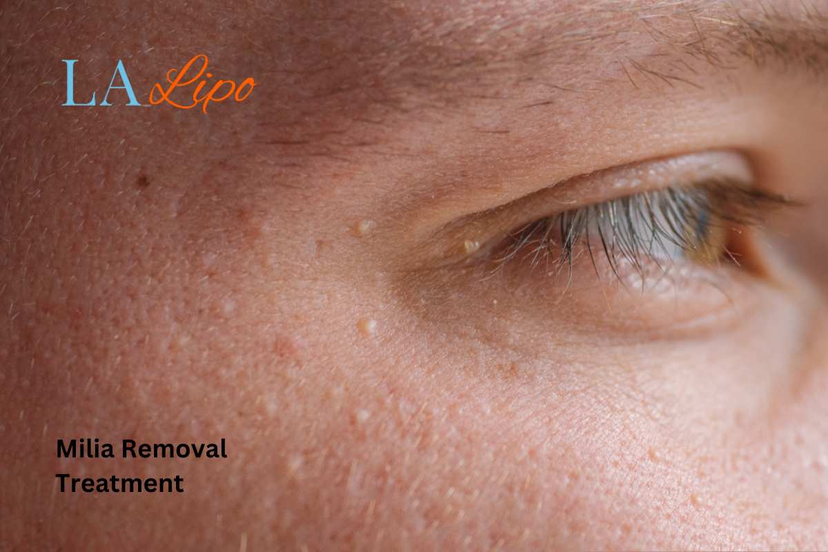Cryopen Milia Removal: Is It the Easiest and Safest Option Chadwell Heath?