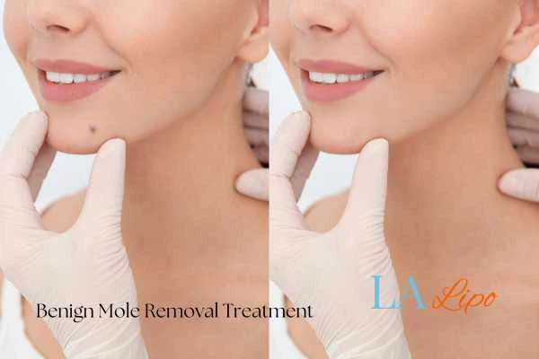woman's before and after mole removal Chadwell Heath results