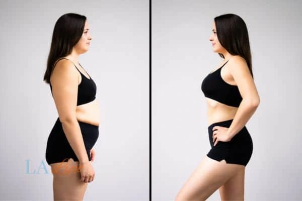 image of woman before and after results of LA-EMS Body Sculpting Chadwell Heath to help treat Diastasis recti