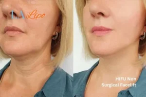 hi-fu for wrinkles Chadwell Heath before and after results