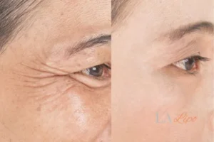 Before and after results of woman - HI-fu wrinkles reduction treatment Chadwell Heath