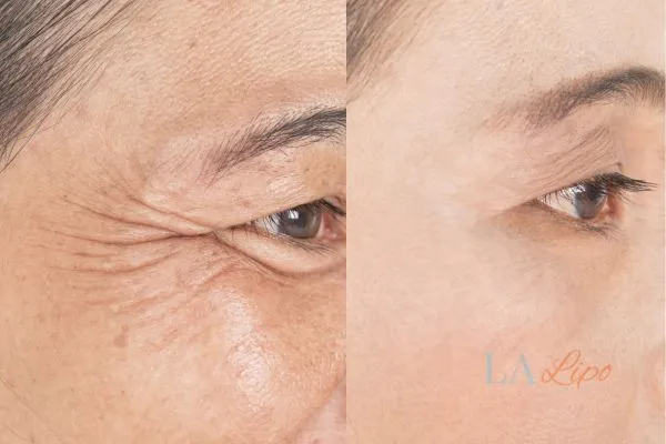 Before and after results of woman - HI-fu wrinkles reduction treatment Chadwell Heath