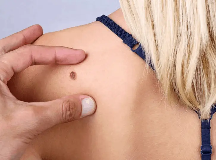 woman having mole removal Chadwell Heath consultation before treatment.