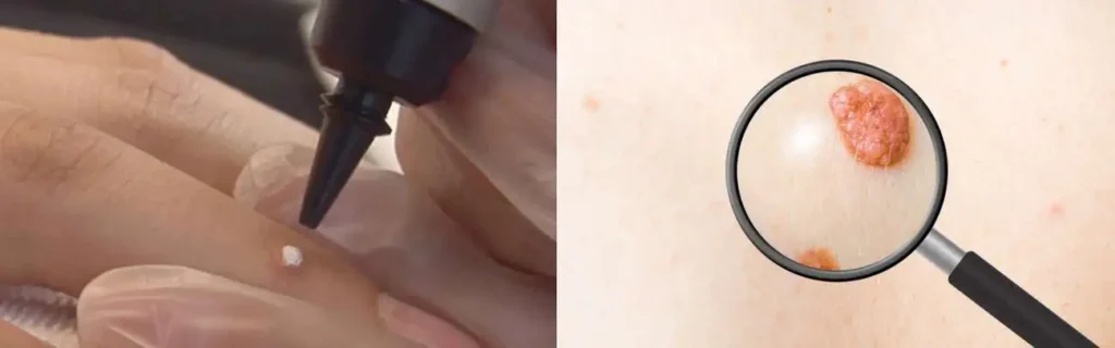 Cryopen for mole removal Chadwell Heath - speak to our team today!