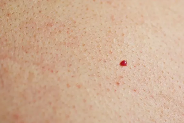 close up of a cherry angioma Chadwell Heath