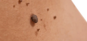 image of a skin tag Chadwell Heath