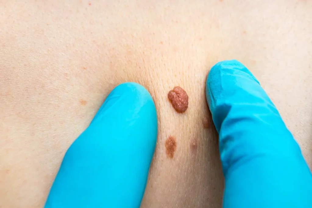 Consultant examining a skin tag Chadwell Heath