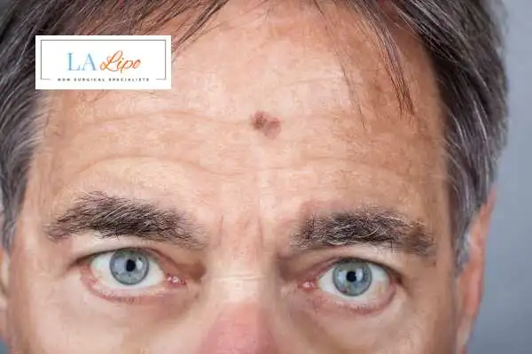 Solar Lentigo Removal Chadwell Heath image of man with mark on his forehead