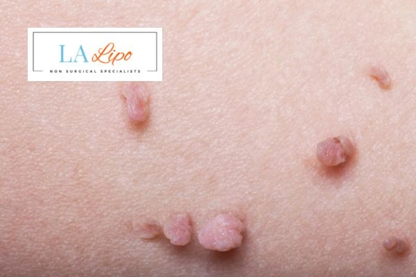 Does cryopen skin tag removal Chadwell Heath hurt? Find out now call our team today!