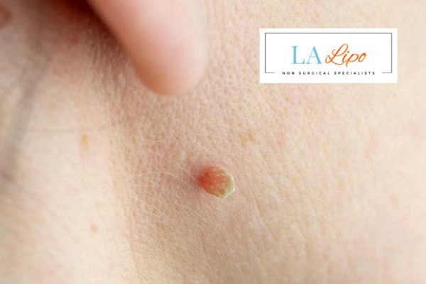 Book skin tag removal Chadwell Heath today speak to our team now!
