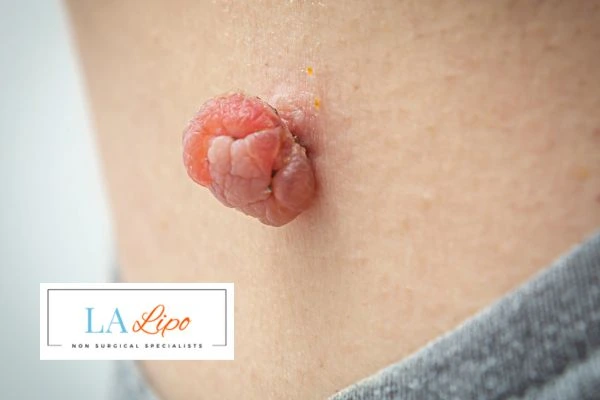 Interested in skin tag removal Chadwell Heath? Concerned about the pain? Find out more today!