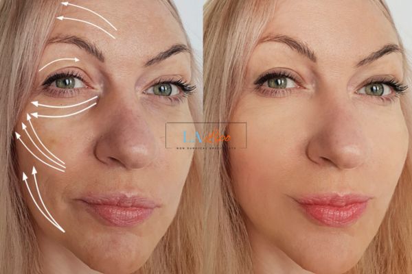 Morpheus 8 results Chadwell Heath face lift.