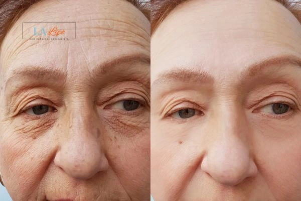 The powerful benefits of Morpheus8 Treatment Chadwell Heath - Call Our team today!