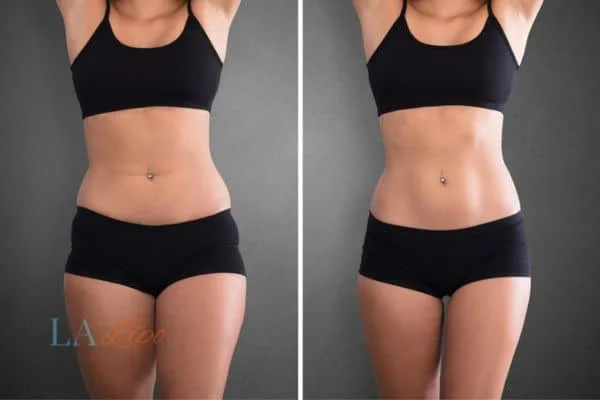 before and after results of non-surgical treatment to help a woman's body image and mental health Chadwell Heath