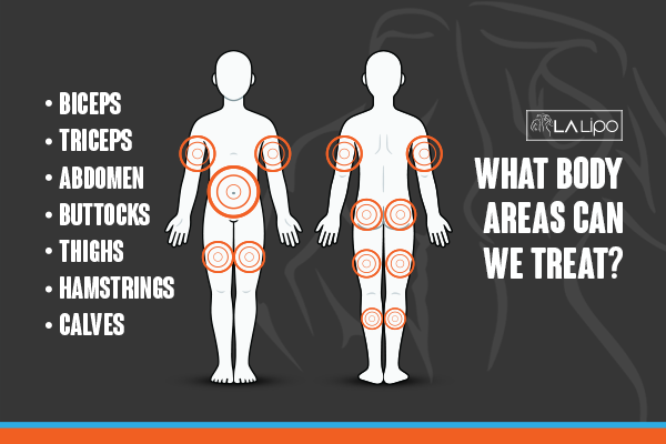 Diagram to show areas you can have LA-EMS Body Sculpting Treatment Chadwell Heath