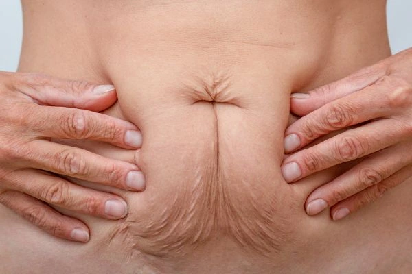 Image of a woman's stomach with loose skin - example of skin tightening Chadwell Heath options
