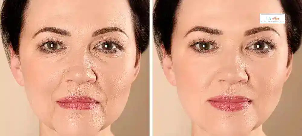How Long Does It Take to See Results and How Long Do They Last Chadwell Heath?