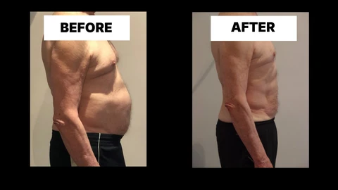 What Symptoms Can Diastasis Recti Cause in Men? Weak Core, Back Pain and Poor Posture Chadwell Heath